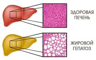 Диета при жировом гепатозе печени, разрешенные и запрещенные продукты