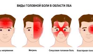 Головная боль в лобной части