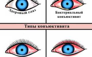 Симптомы и лечение конъюнктивита у ребенка