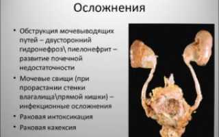 Что такое обструкция мочевыводящих путей