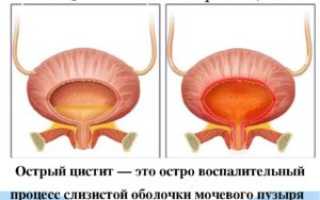 Цистит — это инфекционное заболевание или нет