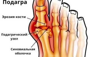 Диета при подагре, что можно, а что нельзя есть