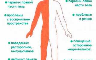 Левосторонний ишемический инсульт