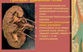 Расщепление синусов почек