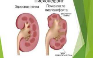 Пиво при пиелонефрите