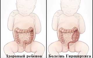 Симптомы болезни Гиршпрунга у детей и как ее лечить