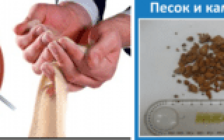 Когда выходит песок с почек