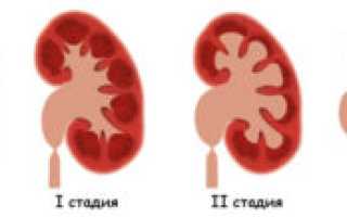 Гидронефроз 3 степени