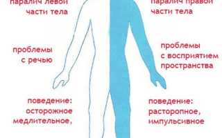 Последствия инсульта головного мозга