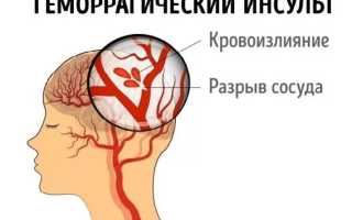 Все о геморрагическом инсульте