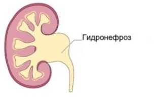 Гидронефроз почек у беременных
