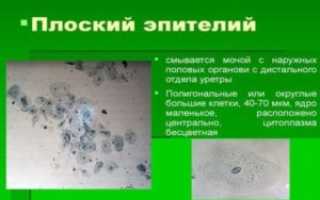 Эпителий плоский в моче