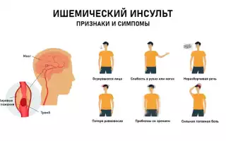 Все об ишемическом инсульте