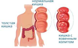 Диета при колите кишечника, меню, разрешенные продукты
