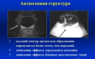 Анэхогенный — что это значит