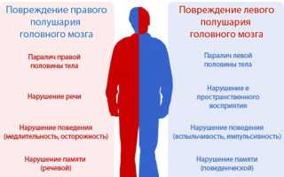 Последствия правостороннего инсульта