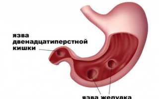 Диета при язве двенадцатиперстной кишки
