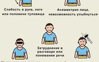 Правосторонний ишемический инсульт