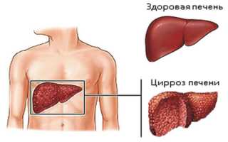 Диета при циррозе печени, что можно, чего нельзя