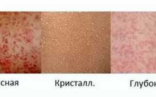 Симптомы потницы у ребенка и как ее лечить