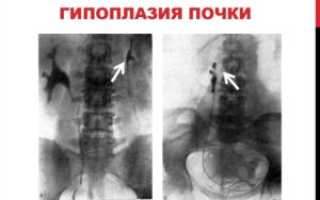 Гипоплазия почки