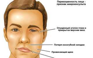 Что несет за собой микроинсульт?