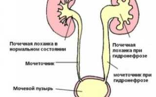 Что такое лоханка почки