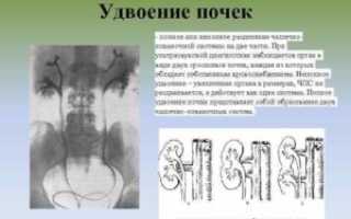 Удвоение почек
