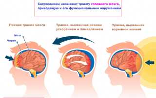 Что нужно делать при сотрясении головного мозга?