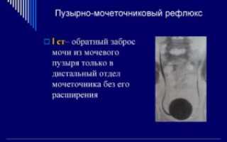 Заброс мочи из мочевого пузыря в почки у детей