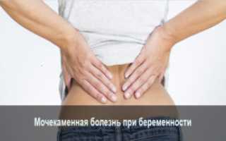 Мочекаменная болезнь при беременности