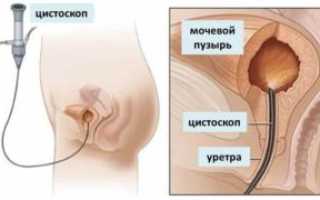 Инсталляция мочевого пузыря