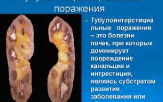 Тубулоинтерстициальный пиелонефрит