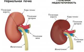 Диета при почечной недостаточности, что можно и нельзя есть