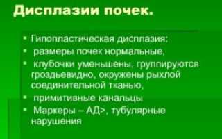 Дисплазия почек