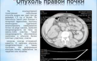 Признаки образования правой почки
