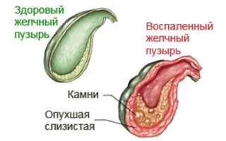 Диета при холецистите желчного пузыря