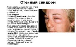 Внешние признаки человека с больными почками