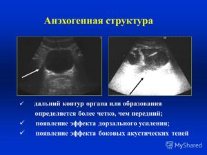 Анэхогенное что значит