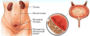 Болит низ живота где мочевой пузырь