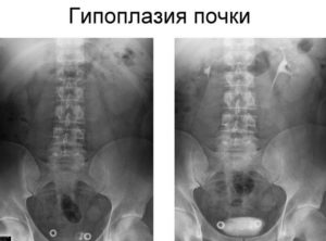 Что такое гипоплазия почки у взрослого человека