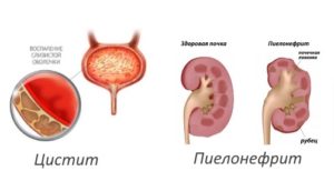 Цистит восходящий пиелонефрит