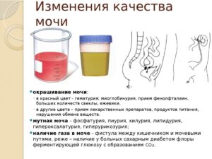 Цвет мочи при цистите у женщин
