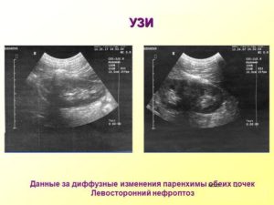 Диффузно неоднородные изменения структуры синусов обеих почек