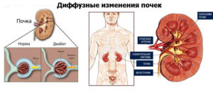 Диффузно неоднородные изменения структуры синусов обеих почек