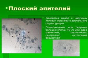 Эпителий плоский в моче норма у мужчин