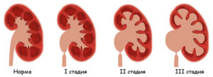 Гидронефроз 3 степени правой почки у ребенка