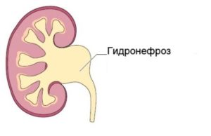 Гидронефроз почек у беременных