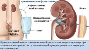Катетер в почке при камнях