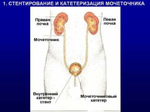 Катетер в почке при камнях